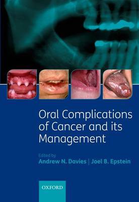 Oral Complications of Cancer and its Management image