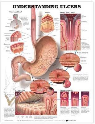 Understanding Ulcers Anatomical Chart image