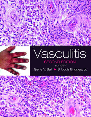 Vasculitis on Hardback by Gene V. Ball