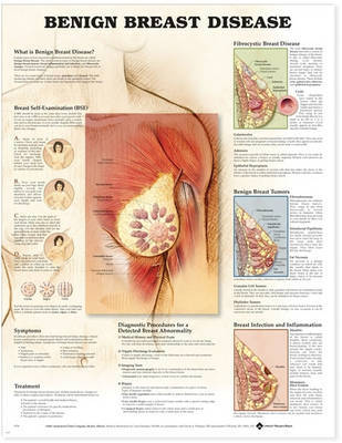 Benign Breast Disease Anatomical Chart