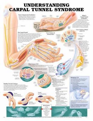 Understanding Carpal Tunnel Syndrome Anatomical Chart image