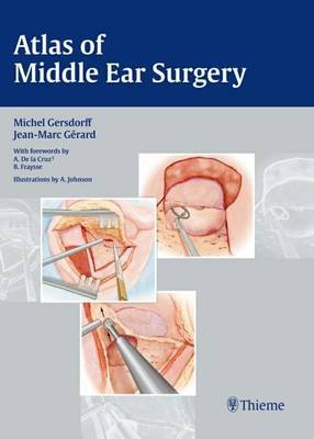 Atlas of Middle Ear Surgery on Hardback by Michel Gersdorff