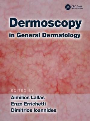 Dermoscopy in General Dermatology image