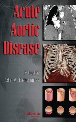 Acute Aortic Disease image