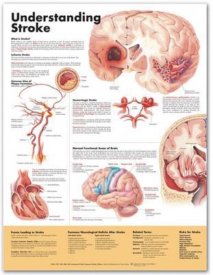 Understanding Stroke Anatomical Chart image