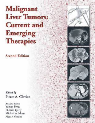 Malignant Liver Tumors by Pierre-Alain Clavien image