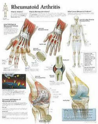 Understanding Rheumatoid Arthritis image