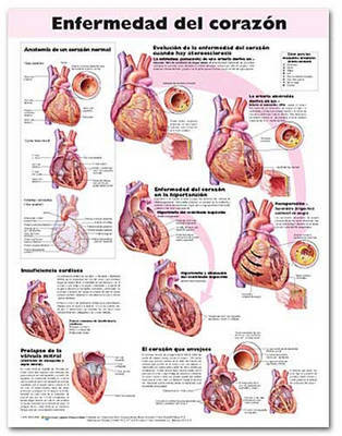 Heart Disease Anatomical Chart in Spanish (Enfermedad Del Corazon) image