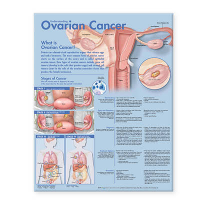 Understanding Ovarian Cancer Anatomical Chart image